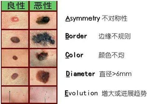 好痣壞痣怎麼分|如何分辨好痣壞痣？專業醫師告訴你辨別方法與注意事項